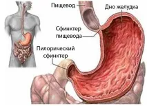Анацидний гастрит симптоми та лікування недуги симптоми