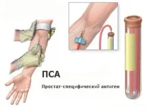 Аналіз ПСА норма, розшифровка за віком та відхилення (таблиця) розшифровка