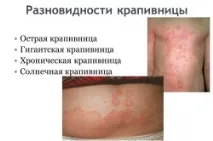 Алергія на воду та її симптоми воду