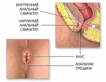 Анальна тріщина анальні