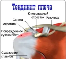 Причини виникнення сухожилля