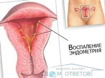 Ендометрит, причини його виникнення та лікування - відповіді та поради на твої питання відповіді