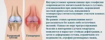 Фактор згортання крові VIII - показання до аналізу, норма, розшифровка аналізу