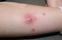 Фурункули на нозі причини, як лікувати фото, що робити, після видалення лікувати