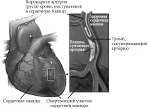 Інфаркт міокарда - Найкращі методи лікування та профілактики інфаркту міокарда - Світлана Володимирівна інфаркт
