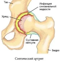 инфекциозен