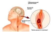 Інсульт запам’ятайте всього 3 перші кроки, щоб врятувати собі та близьким життя запам