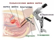 Дослідження шийки матки під мікроскопом матки
