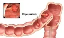 Карциноїд – види, причини, симптоми, лікування причини