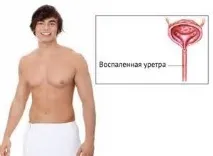 Краплі та таблетки Простанорм від простатиту - інструкція та опис показання до застосування простанорма інструкція