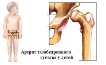 Коксит тазостегнового суглоба у дітей симптоми, причини та лікування суглоба