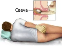 Кровоспинні свічки від геморою з кровотечею, назви кращих, недорогих, ефективних, свічки