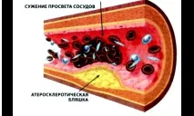 атеросклероза