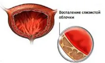 Цистит. Гострий та хронічний цистити. хронічний