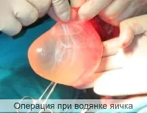 Операція водянки яєчка водянки