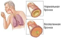 Відхаркувальні та розріджуючі мокротиння засоби мокротиння