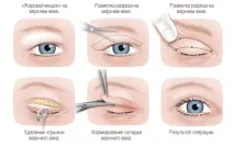 Блефаропластика протипоказання до операції, побічні ефекти, фото протипоказання