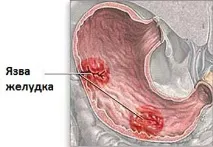 Причини та лікування болю в грудях та попереку причини