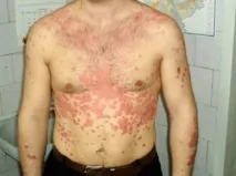 Хвороби схожі на псоріаз лишай, болячки та інші хвороби
