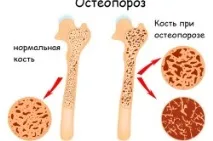 Сильні болі в попереку що робити, причини у жінок, вагітних та чоловіків сильні
