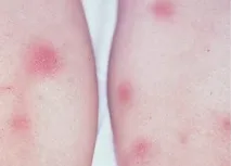 Синдром Лефгрена Лефгрена