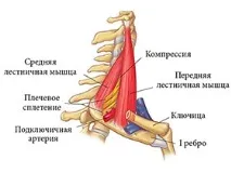 Симптоми остеохондрозу шиї порушення