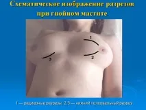 захворювань