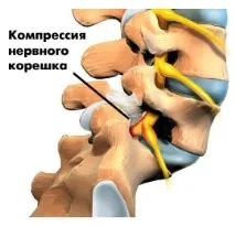 Симптоми спондилолістезу поперекового відділу хребта спондилолістезу