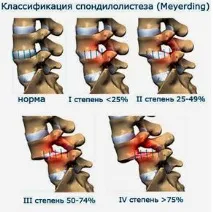 Симптоми спондилолістезу поперекового відділу хребта симптоми