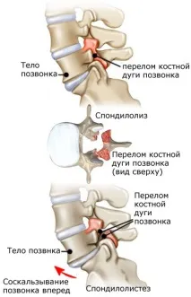 Симптоми спондилолістезу поперекового відділу хребта відділу