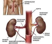 Стеноз ниркової артерії симптоми та лікування стеноз