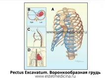 Типи деформації грудної клітки, Інтернет-журнал клітки