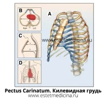 Типи деформації грудної клітки, Інтернет-журнал клітки