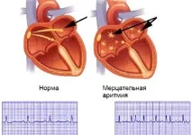 Увечері аритмія – Лікування Серця увечері