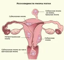 матки