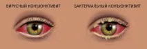 Вірусний та бактеріальний кон’юнктивіт. вірусний