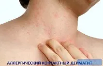 Алергічний контактний дерматит. алергеном