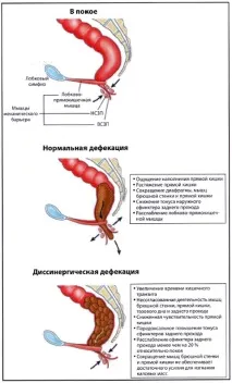 дефекация