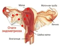 Ендометріоз. Що то за хвороба? ендометріозу