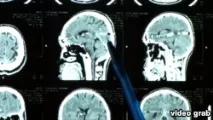Бішкекські лікарі зіткнулися з унікальним випадком, витягнувши кулю з голови пацієнта бішкекські