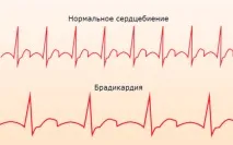 Брадикардія серця Що це таке, чим вона небезпечна, лікування в домашніх умовах брадикардія