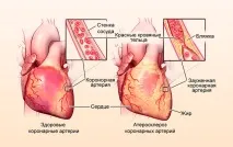 Брадикардія серця Що це таке, чим вона небезпечна, лікування в домашніх умовах небезпечна
