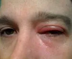 Демодекоз повік - причини, симптоми, діагностика та лікування демодекоз