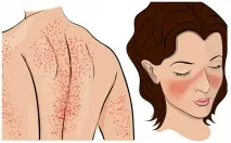 дискоїдний