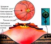 емболія