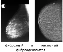 Фіброаденоматоз молочних залоз та його види (дифузний та локалізований, фіброзний та кістозний) його