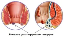 Діагностика геморою геморою