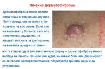 Дерматофіброма - фото та особливості захворювання дерматофіброми