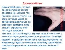 Дерматофіброма - фото та особливості захворювання дерматофіброми