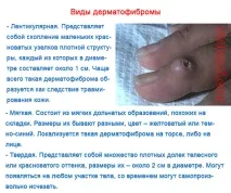 Дерматофіброма - фото та особливості захворювання дерматофіброма